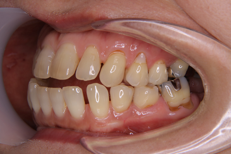 受け口で開咬の女性の歯並び画像