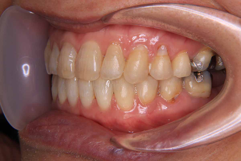 受け口で開咬だった歯並びを矯正した後の画像