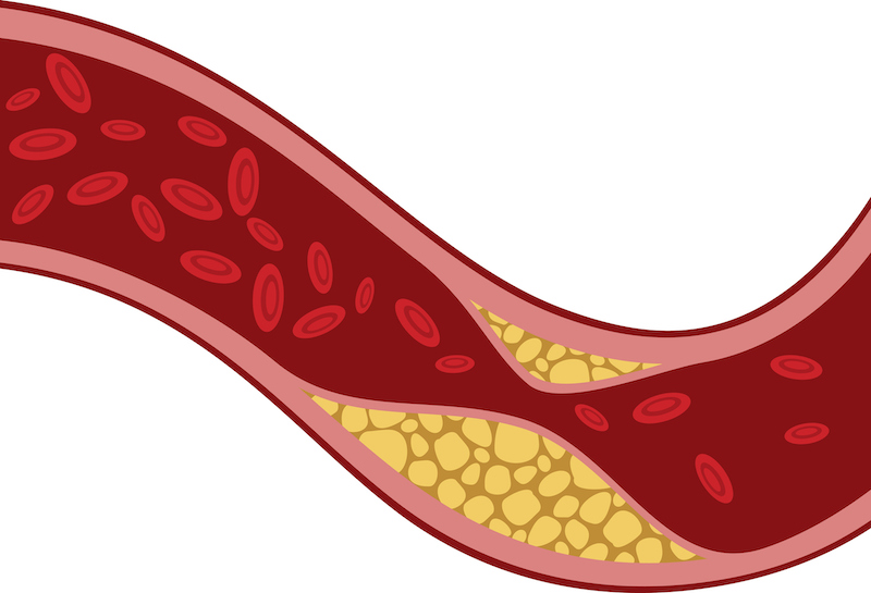 悪玉コレステロールが多い人の血管のイメージイラスト