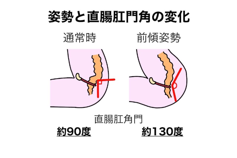 姿勢と直腸肛門角の解説図