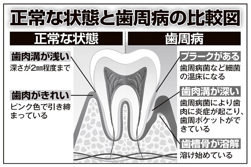 正常な状態と歯周病の比較図